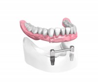 Appareilcomplet sur 2 implants dentaires - Dentiste Paris