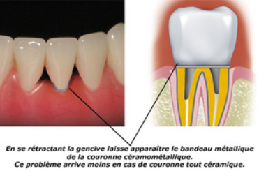 Coloration dentaire - Dentiste Paris
