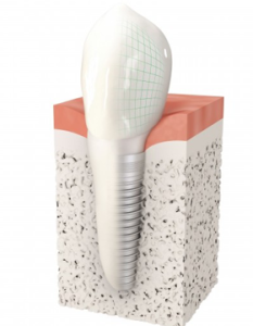 Implant dentaire Paris - Dentiste Paris