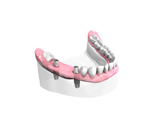 Mise-en-place-des-implants-dentaires - Dentiste Paris