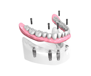 Mise en place des implants dentaires - Dentiste Paris