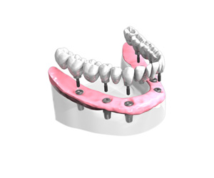 Pose d un bridge complet sur implants dentaires All-on-6 - Dentiste Paris