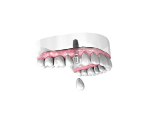Pose d une couronne dentaire sur implant - Dentiste Paris